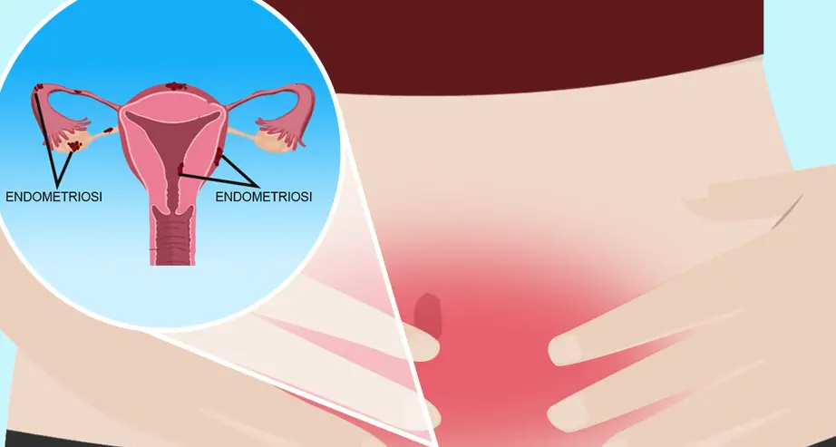 «Endometriosi, una malattia assurda di fronte alla quale lo Stato è cieco e sordo»